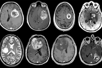 10-02-2021 Glioblastoma, tumor cerebral agresivo