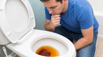 Hombre de camiseta azul y pantalón vaquero observa la orina de color marrón oscuro dentro de un inodoro blanco con la tapa abierta.