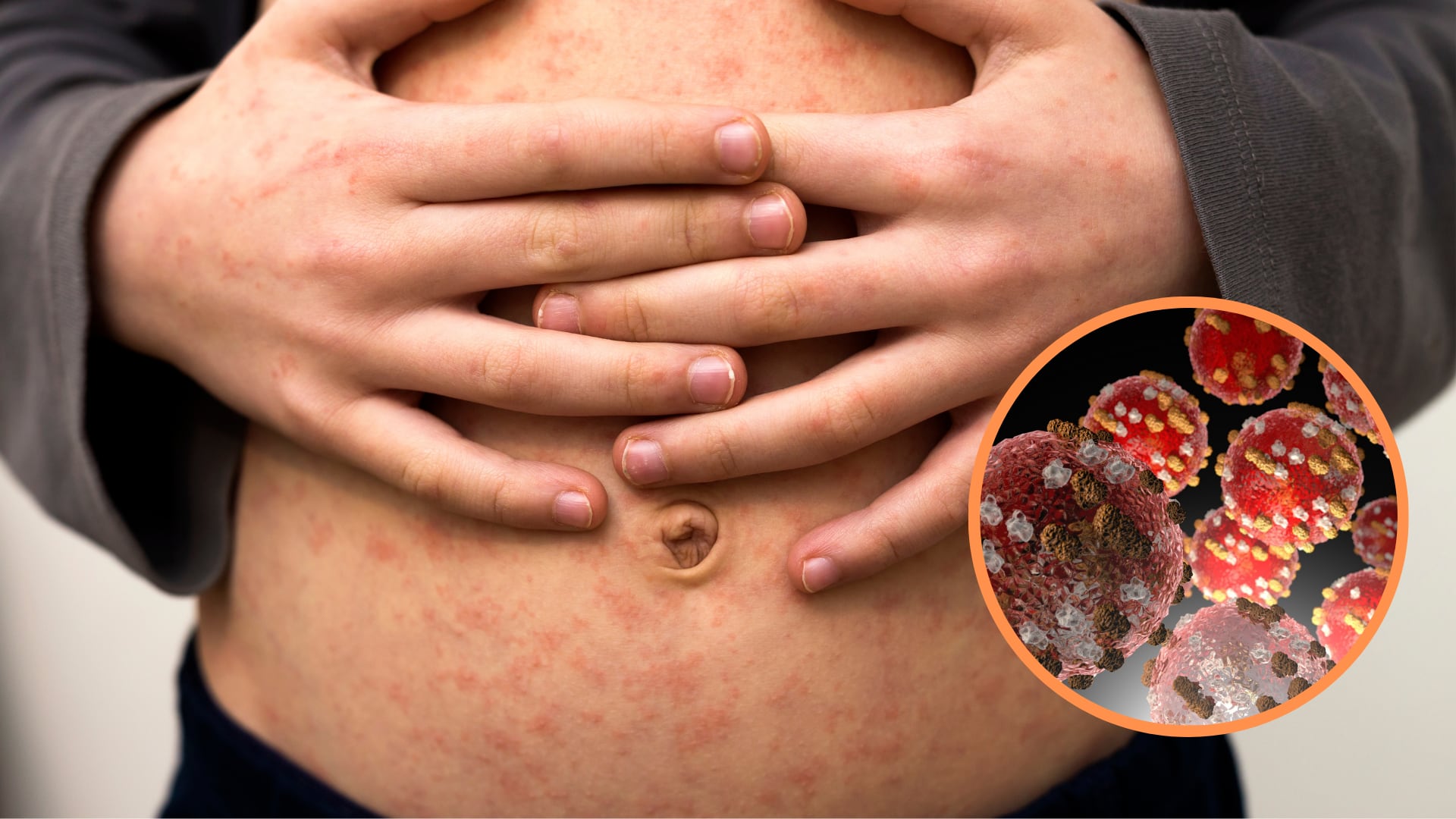 El CDC Perú insta a los centros de salud a identificar casos sospechosos y vacunar a niños entre 1 y 6 años para prevenir brotes. (Composición: Infobae)