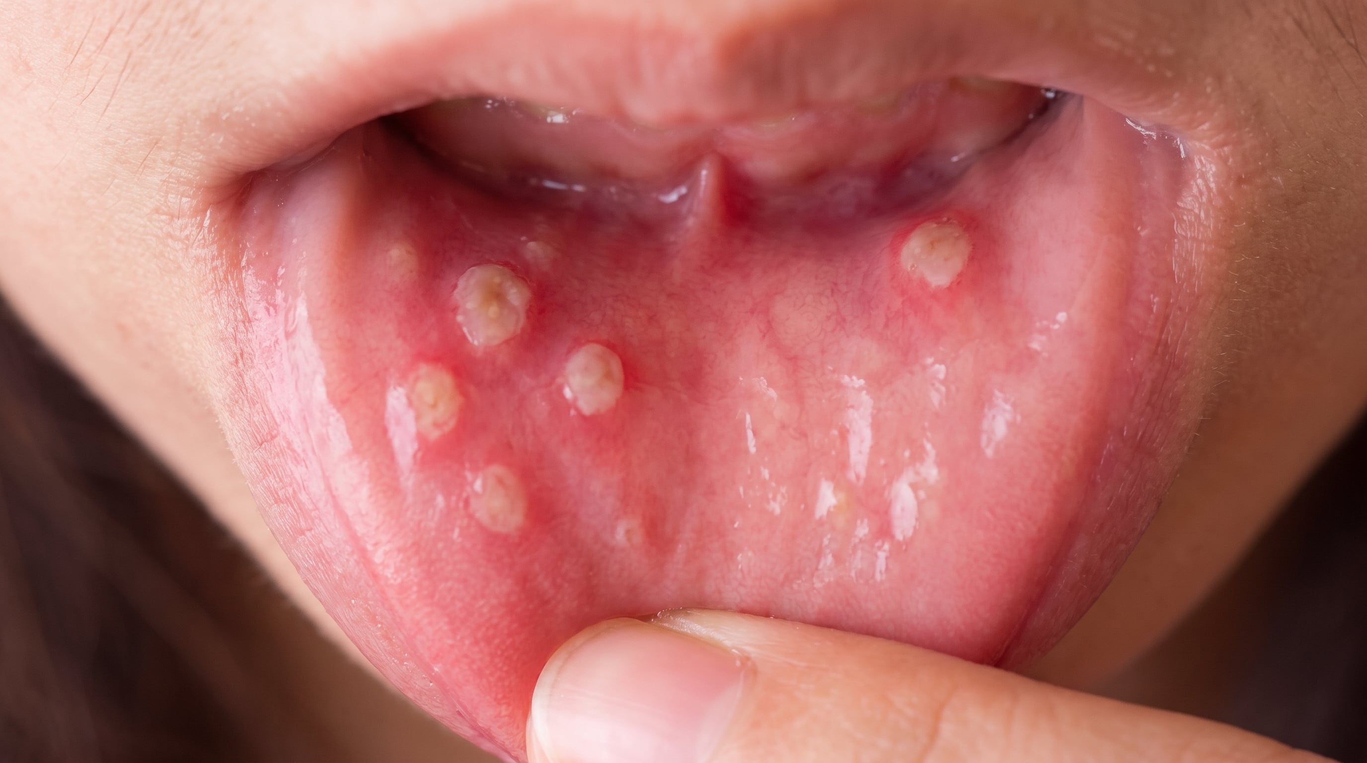 Las aftas surgen en el tejido blando del interior de la boca, mientras que el herpes labial aparece habitualmente en los labios o en la piel circundante (Imagen Ilustrativa Infobae)