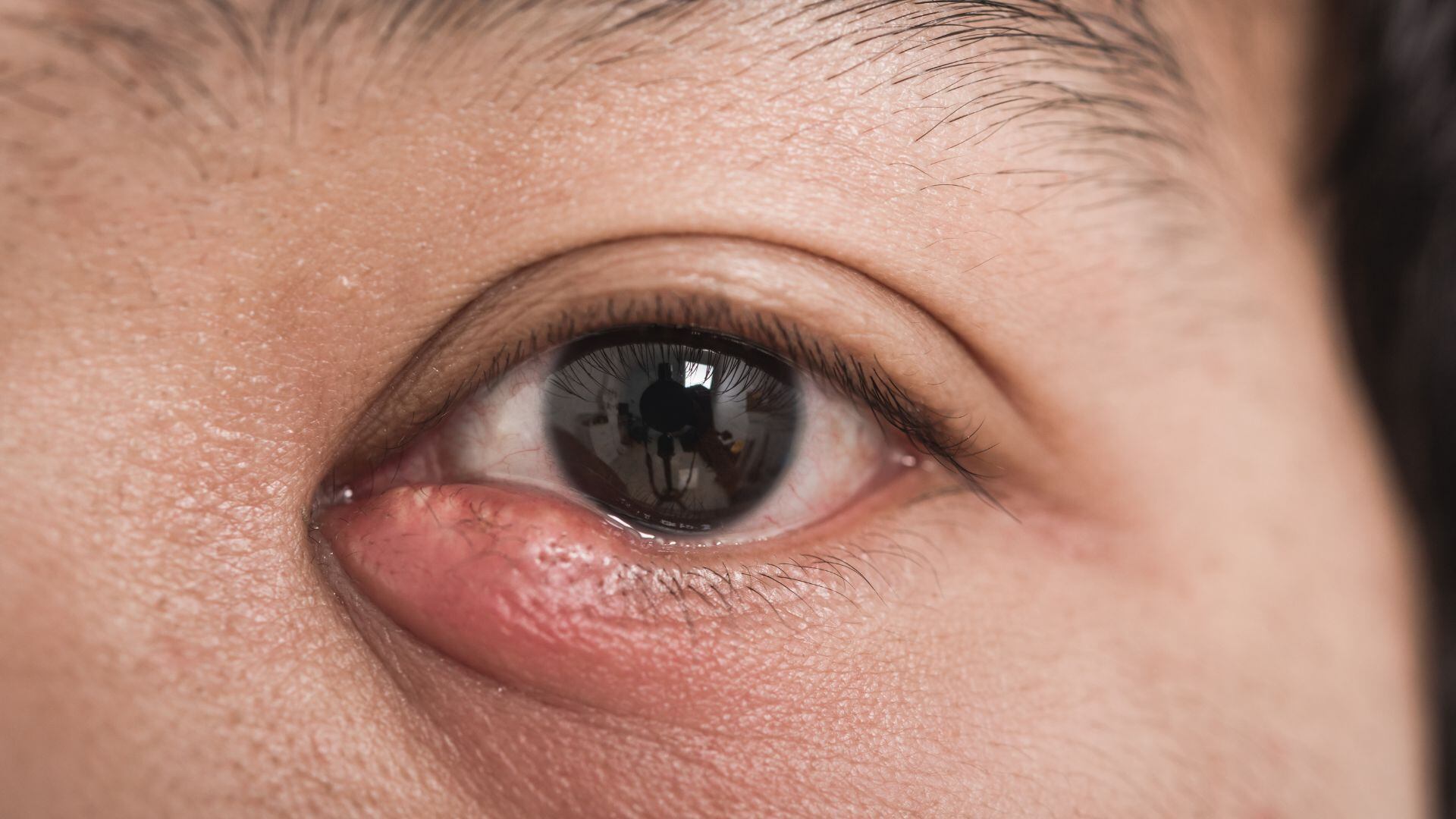 El orzuelo es una infección aguda y localizada de una glándula sebácea en el párpado (Canva)