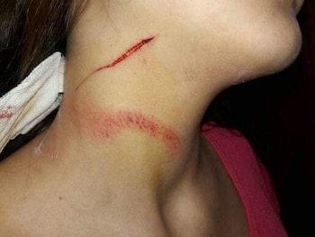 Una de las heridas que