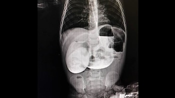 Los especialistas identificaron una atresia duodenal, condición que impide la formación adecuada del intestino y bloquea el paso de los alimentos, lo que dificultó su diagnóstico temprano - Créditos: Essalud.