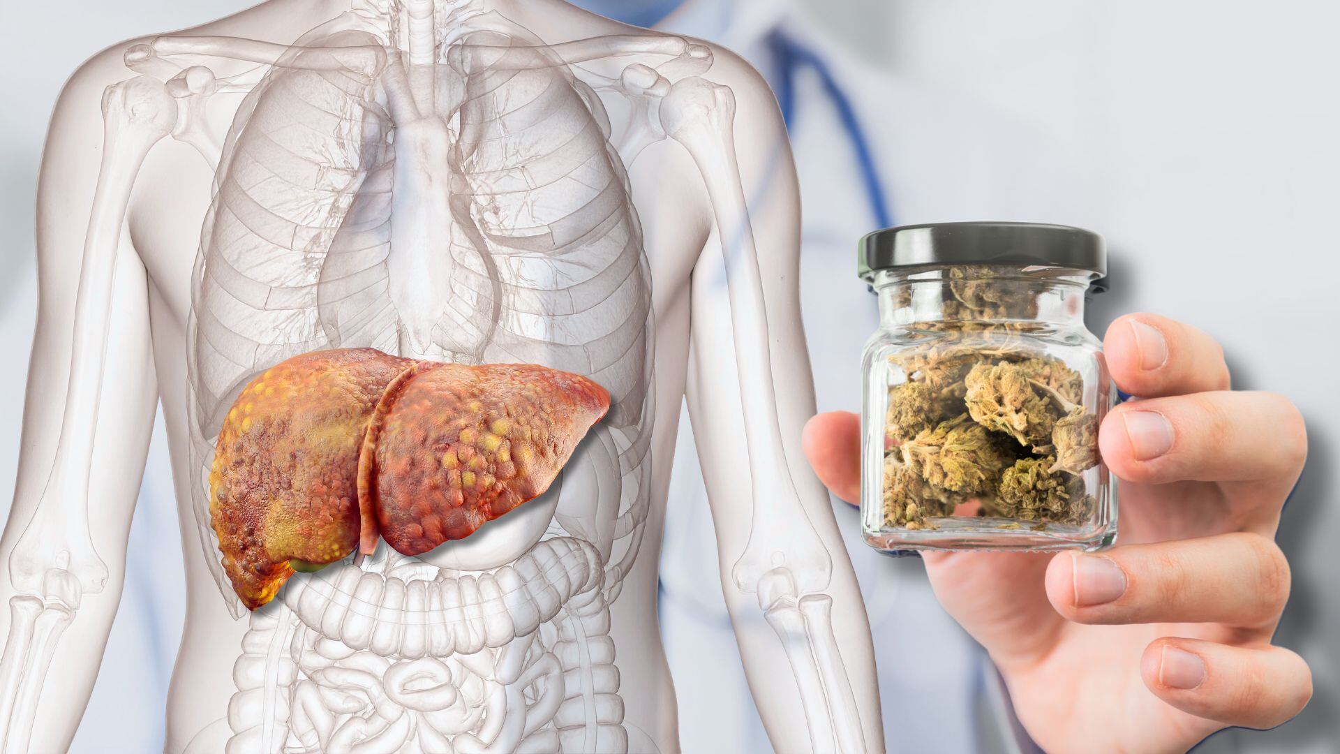 Un compuesto del cannabis puede revertir la enfermedad en el hígado graso sin causar intoxicación (Montaje Infobae)