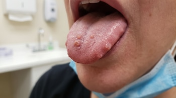 Primer plano de la lengua de una persona con bultos. Se ve parte de la barbilla con una mascarilla azul. El fondo desenfocado muestra un consultorio.