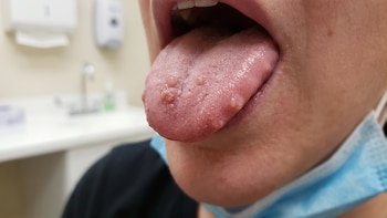 Bultos en la lengua: qué los causa y cuándo conviene consultar