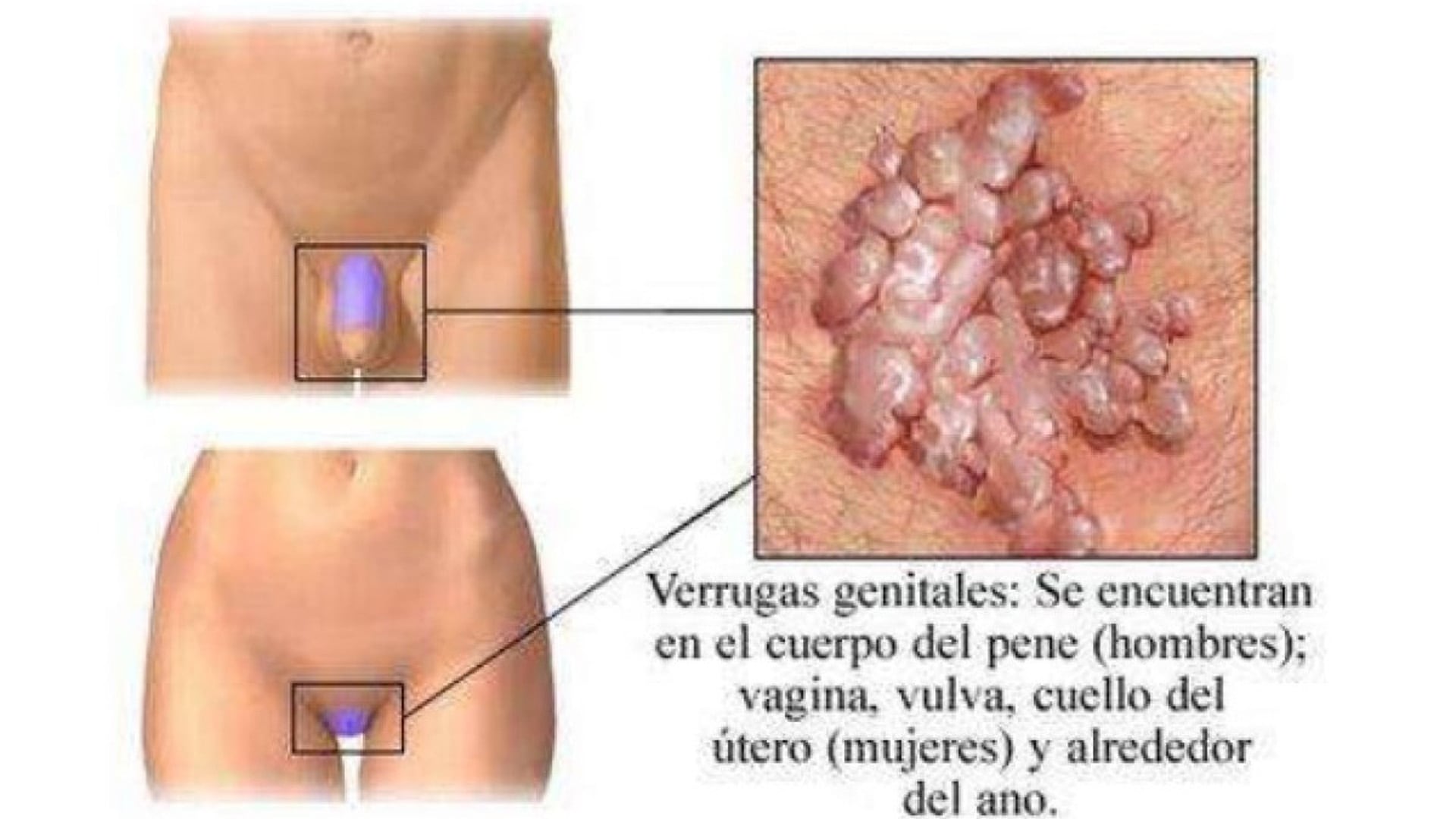 Efectos de la clamidia al no ser tratada