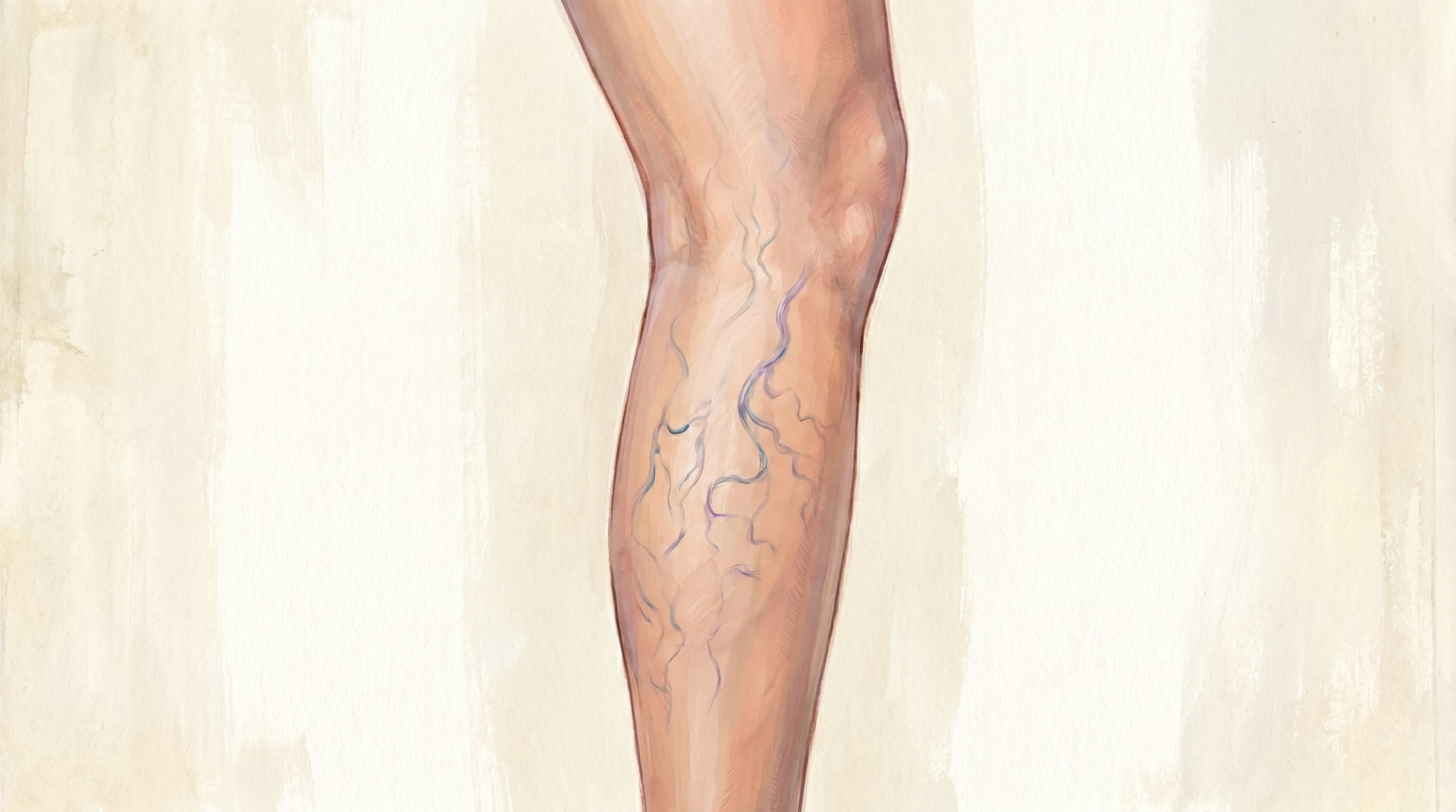 Las varices aparecen cuando las válvulas venosas no cierran bien, la sangre se acumula y aumenta la presión en la vena (Imagen Ilustrativa Infobae)