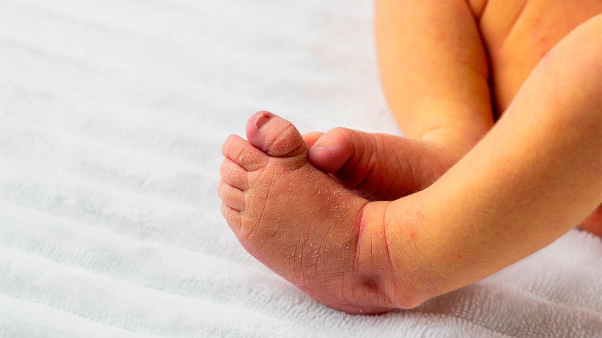 Ictericia neonatal. (UPV)