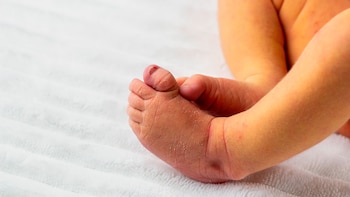 Ictericia neonatal. (UPV)