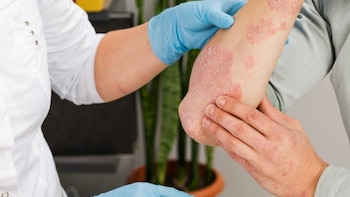 Lupus cutáneo: síntomas, tratamientos y