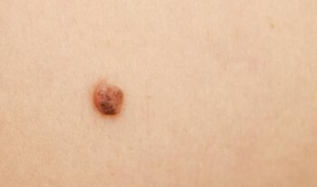 Los lunares pueden no ser