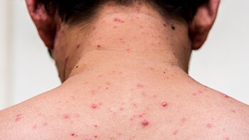 Argentina está cursando un brote