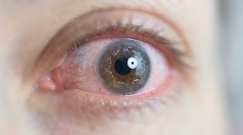 Primer plano de un ojo abierto con vasos sanguíneos visibles en la esclerótica y una capa irregular sobre el iris y la pupila.