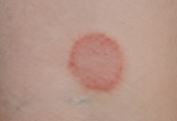 El primer caso detectado en