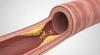 Las variantes genéticas responsables del
