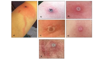 La transmisión del Alaskapox se