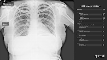 La tecnología de Qure.ai