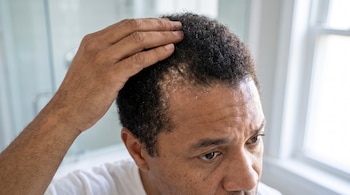 Un hombre sostiene su cabello corto, exponiendo la piel seca y escamosa en la parte superior de la frente y el cuero cabelludo.