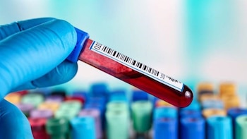 Análisis de sangre de nueva generación mejora la detección del cáncer de próstata agresivo