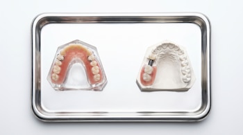 Una bandeja metálica sobre fondo blanco muestra una prótesis dental removible con ganchos y un implante dental fijo con tornillo de titanio y corona.