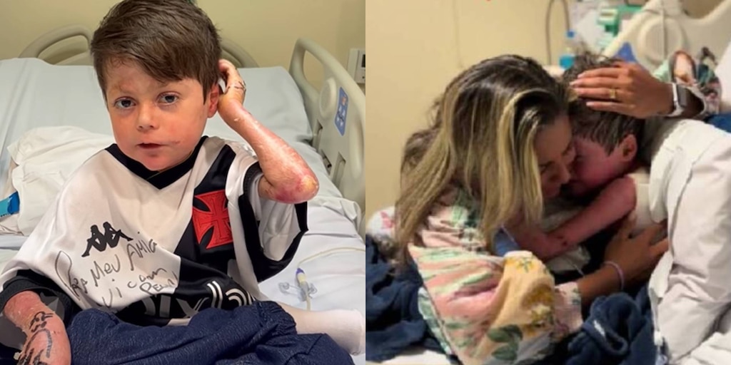 La dura vida de Guilherme, el nene con “piel de mariposa” que despertó tras 16 días en coma - Infobae