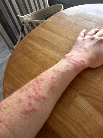 Fue a un hotel por una noche y terminó cubierta de picaduras de chinches