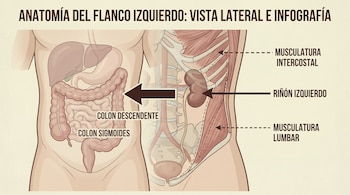 Infografía de la anatomía del flanco izquierdo que muestra el colon descendente, colon sigmoides, riñón izquierdo, musculatura intercostal y lumbar.