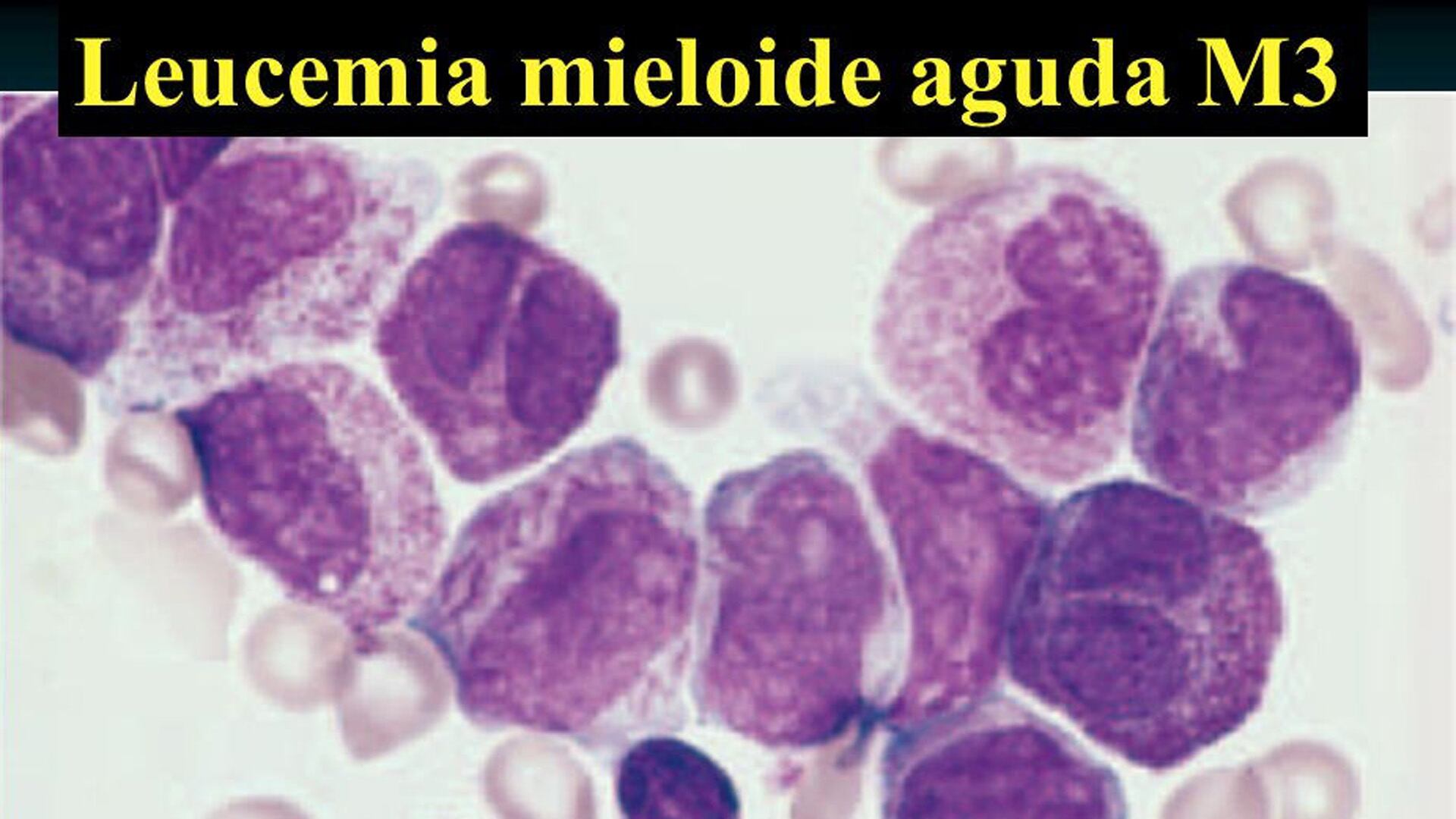 El subtipo de leucemia con Inversión 3 que padece Schlossberg representa solo el 1-2% de los casos y tiene muy pocas opciones de tratamiento