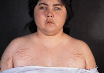 El cortisol elevado en exceso