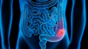 Aumentan los casos de cáncer