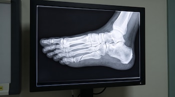 Un monitor de marco negro muestra la radiografía de los huesos de un pie sobre fondo oscuro.