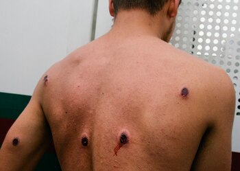 Un manifestante muestra las heridas