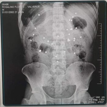 Radiografía tomada a Rosalino Florez,