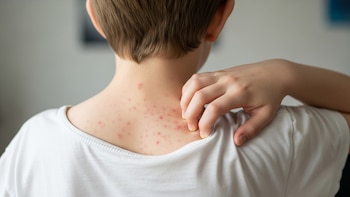 El brote de sarampión en