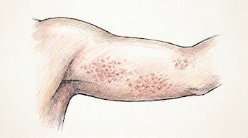 Dibujo artístico de un brazo con la piel afectada por Queratosis pilaris, mostrando múltiples pequeñas protuberancias rojizas sobre un fondo blanco.