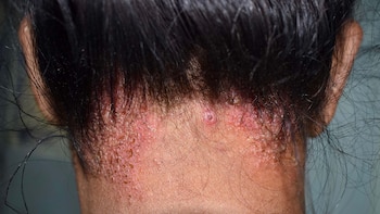 dermatitis seborreica en el cuero cabelludo