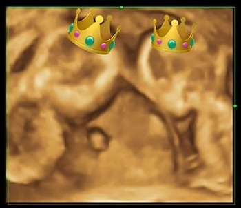 La ecografía de las bebas