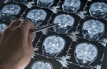 Un estudio señala que una molécula logra "reprogramar" las defensas del cerebro frente al alzhéimer (Europa Press)