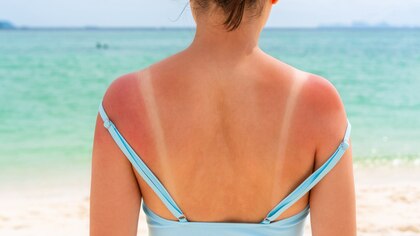 Una dermatóloga explica qué debemos hacer si nos hemos quemado con el sol