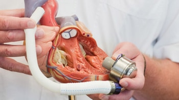 Medicina privada mexicana logra primer implante de corazón artificial: así es la tecnología que podría ser una alternativa al trasplante