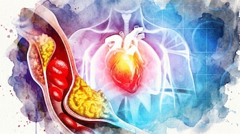 Ilustración acuarela de un corazón humano brillante y una arteria seccionada con glóbulos rojos y una gran acumulación de placa amarilla.