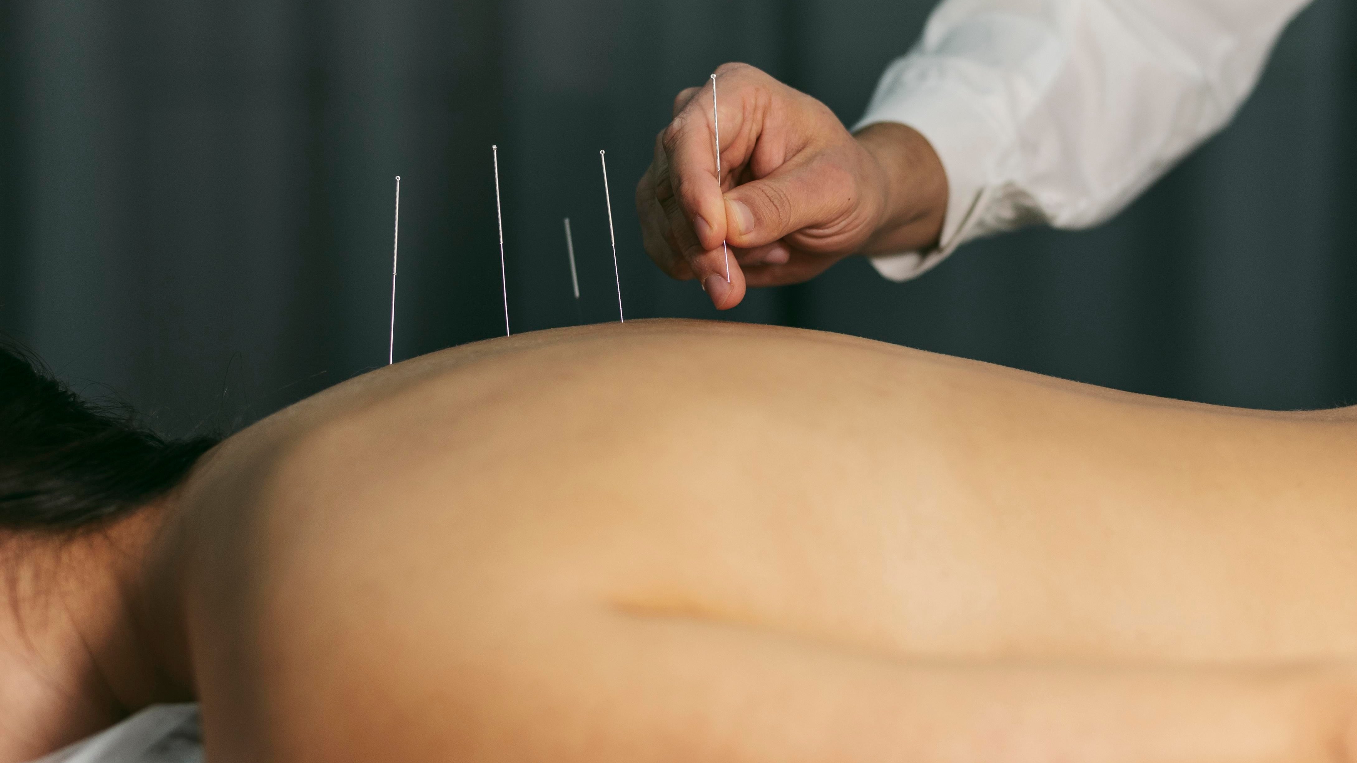 Solo el 3,75% de quienes reciben acupuntura declara dolor relevante al insertar las agujas, informa un estudio especializado