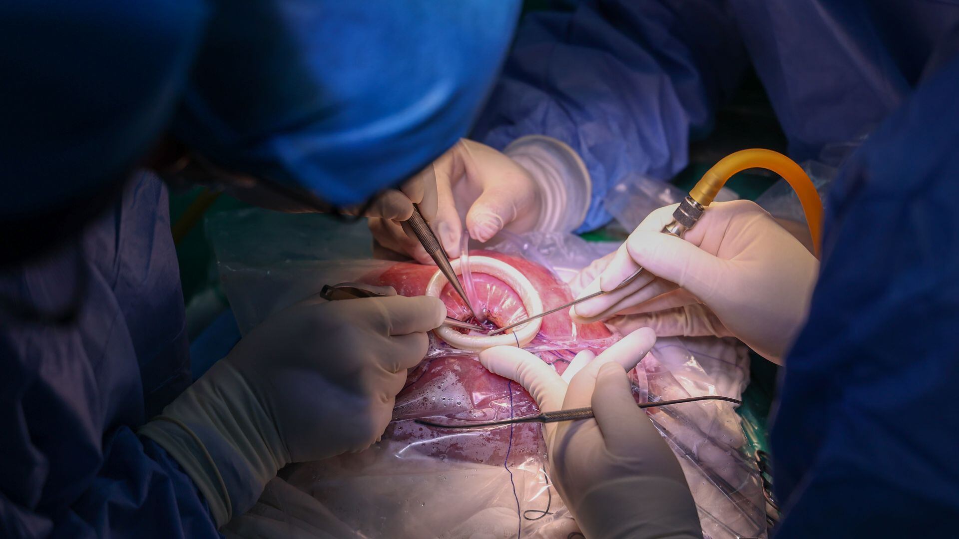 Tras la intervención, el útero fue cerrado y reinsertado en el abdomen materno, y madre e hijo continúan el embarazo bajo seguimiento estricto, con el desafío de alcanzar las 38 semanas de gestación - Créditos: Essalud.