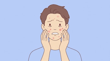Ilustración de una persona con acné en el rostro y las manos sobre sus mejillas ante un fondo azul.