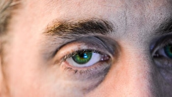 Por qué aparecen las ojeras,