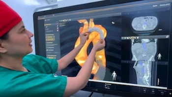 Innovador procedimiento en la arteria aorta salva la vida de un paciente en Panamá