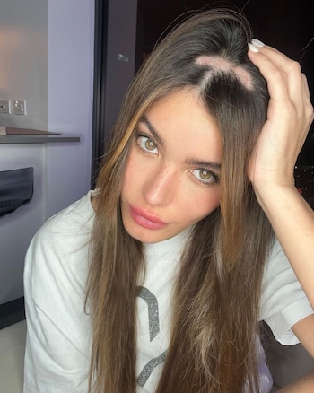 Aunque la alopecia tiene diferentes