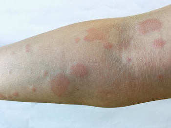 Brazo con lupus (Shutterstock)