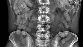 Radiografía con gran cantidad de